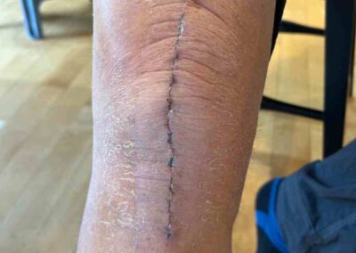 Bandage Removed, Week Two