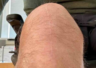 Knee Ten Months After