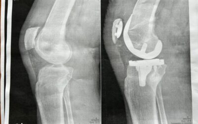 Total Knee Replacement Journal