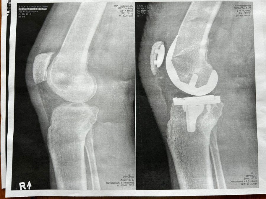 Total Knee Replacement Journal